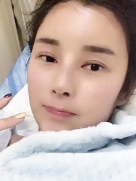 做了面部填充和隆鼻,恢复越来越自然了~