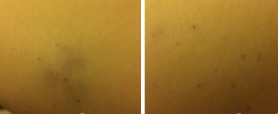 注射瘦腿案例 注射瘦腿果怎么样?注射瘦腿果案例图