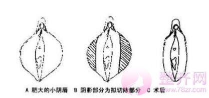 私密整形的小秘密,你知道所多少?