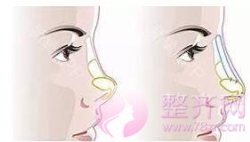隆鼻之后鼻子会“坍塌”?