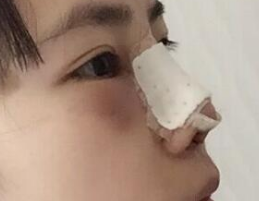 隆鼻失败修复案例分享~希望给大家一些借鉴的!