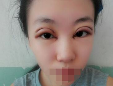 双眼皮案例日记 一位北京肿泡眼妹子的双眼皮案例