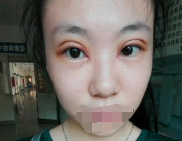 双眼皮案例日记 一位北京肿泡眼妹子的双眼皮案例