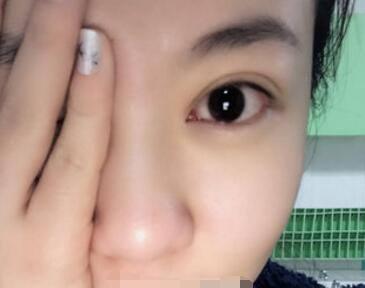 双眼皮案例日记 一位北京肿泡眼妹子的双眼皮案例