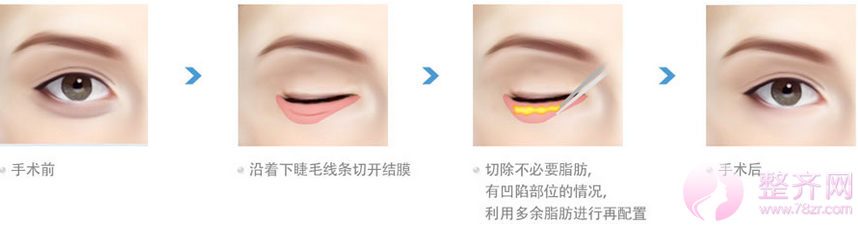 眼部、鼻部、隆胸、的切口都藏在哪里?