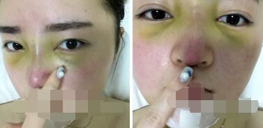求美者的隆鼻案例!真的美了好多!