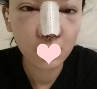 在南宁做的鼻部手术手术,果超喜欢~