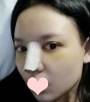 在南宁做的鼻部手术手术,果超喜欢~