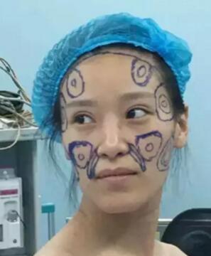 做了自体脂肪填充后,回到了我的少年时代,哈