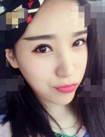 做了自体脂肪填充后,回到了我的少年时代,哈