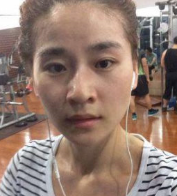 全脸脂肪填充手术一个月了,柔和的脸型才美