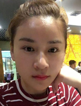全脸脂肪填充手术一个月了,柔和的脸型才美