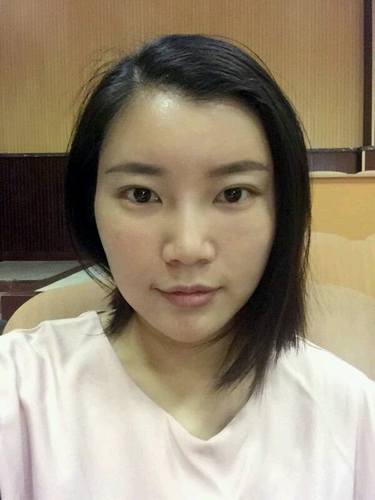 自体脂肪填充术后40天.。很真实的图片!欢迎对比,欢迎拍砖!