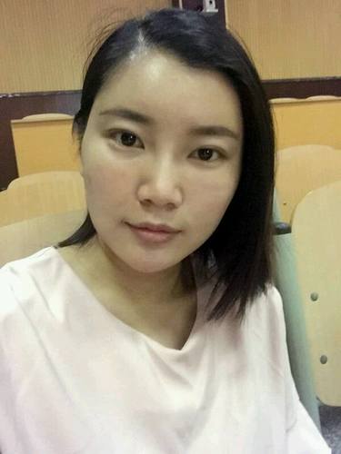自体脂肪填充术后40天.。很真实的图片!欢迎对比,欢迎拍砖!