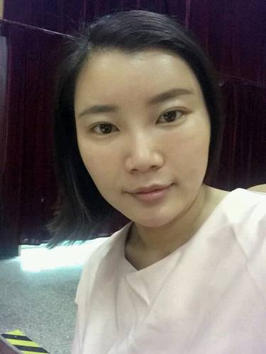 自体脂肪填充术后40天.。很真实的图片!欢迎对比,欢迎拍砖!