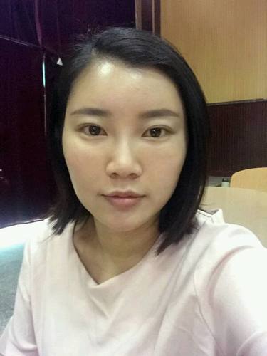自体脂肪填充术后40天.。很真实的图片!欢迎对比,欢迎拍砖!