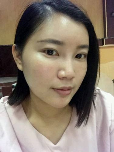 自体脂肪填充术后40天.。很真实的图片!欢迎对比,欢迎拍砖!