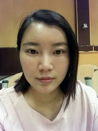 自体脂肪填充术后40天.。很真实的图片!欢迎对比,欢迎拍砖!
