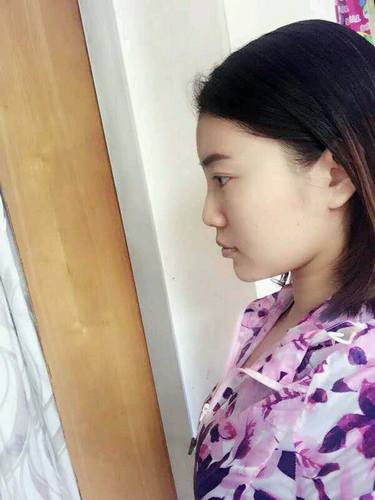 自体脂肪填充术后40天.。很真实的图片!欢迎对比,欢迎拍砖!