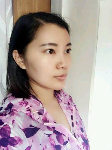 自体脂肪填充术后40天.。很真实的图片!欢迎对比,欢迎拍砖!