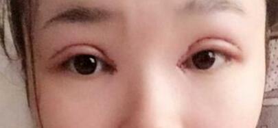 八大处做的全切双眼皮2个月啦!