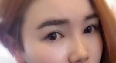 八大处做的全切双眼皮2个月啦!