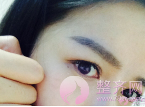 双眼皮成本那么低,凭什么收费那么贵?