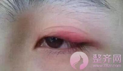 双眼皮成本那么低,凭什么收费那么贵?