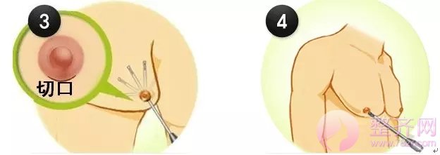 隆胸:到底选假体隆胸还是自体脂肪隆胸呢?
