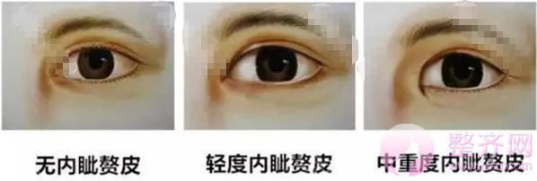 是不是单眼皮做手术就一定要开眼角呢?