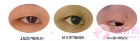 是不是单眼皮做手术就一定要开眼角呢?