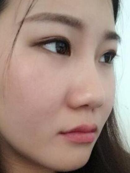 【日记】自体肋软骨隆鼻日记分享,美得不行了