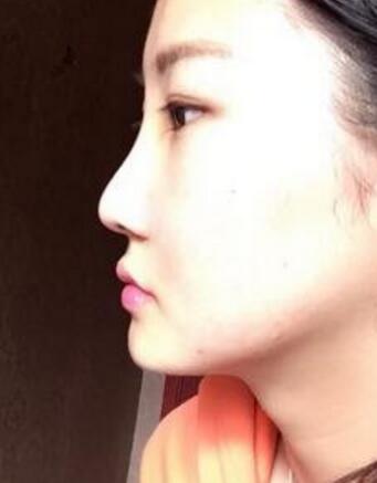 【日记】自体肋软骨隆鼻日记分享,美得不行了