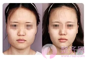 如何拥有精致小V脸?