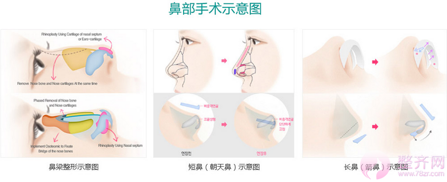 隆鼻材料,该用硅胶,膨体,埋线提升,还是玻尿酸