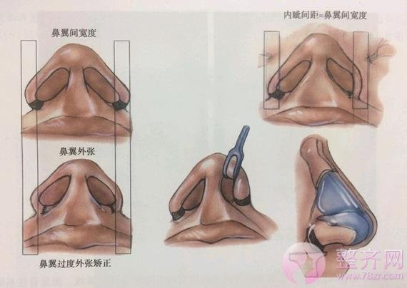 隆鼻之后,还能愉快地玩“猪鼻子”吗?