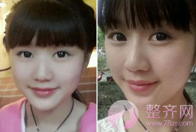 隆鼻之后,还能愉快地玩“猪鼻子”吗?