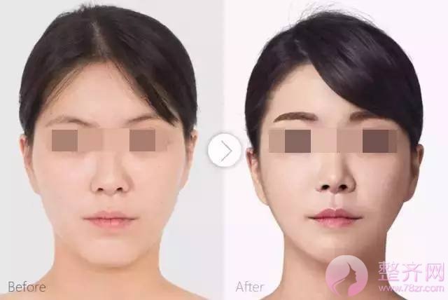 注射隆鼻、隆鼻、假体隆鼻,究竟哪种好?