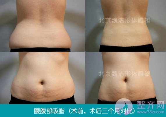 吸脂需谨慎,可能会留疤?
