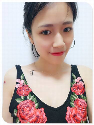 自体脂肪填充全脸案例走起!今天为大家分享的是自体脂肪!有妹子要求多上传点面部填充的案例!小主就上传了,你看我对你们多好,你想要的,你想了解的案例,我都给你!么么哒!