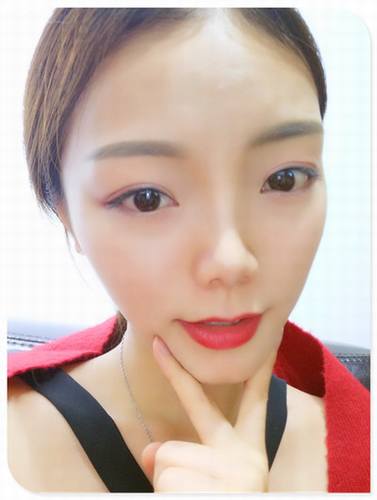 哎呀!有妹子主动反馈做鼻部手术的案例!小主十分高兴!这不,马上发来给大家瞧瞧!这还是自体软骨隆鼻哦!个人觉得这鼻子真心好看!完美!perfect!手动比心!比心!