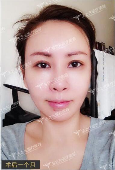 北京玉之光脂肪填充案例 北京玉之光脂肪填充案例分享