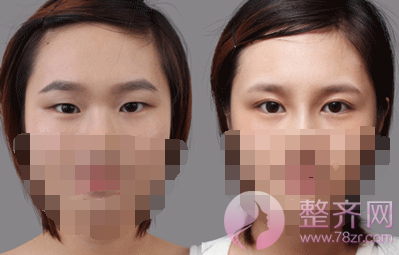你适合做双眼皮手术吗?