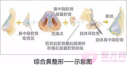 隆鼻和鼻部手术差别在哪?哪种更自然?