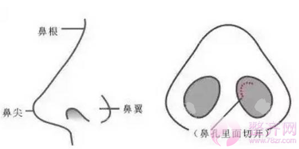 隆鼻和鼻部手术差别在哪?哪种更自然?