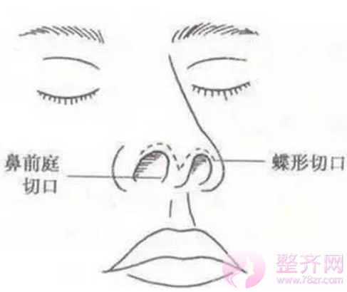隆鼻和鼻部手术差别在哪?哪种更自然?