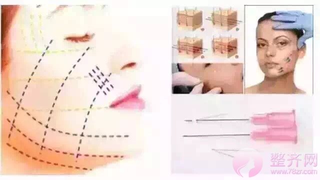 埋线提升提升能维持多久?