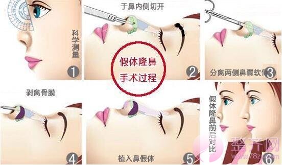 隆鼻:跟恋爱一样,适合你的就是较好的!