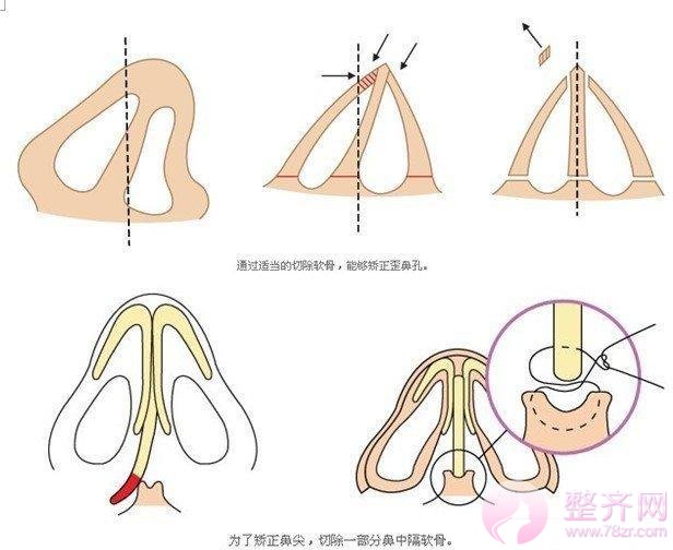隆鼻:跟恋爱一样,适合你的就是较好的!