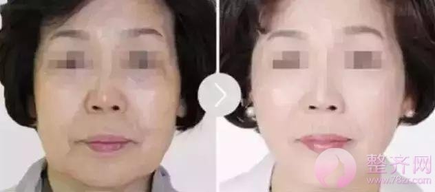 大家都在做的埋线提升你做了吗?